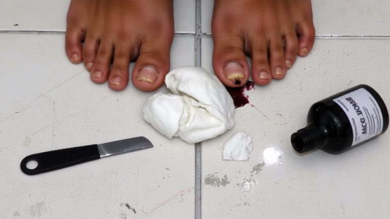 cutting nails too short