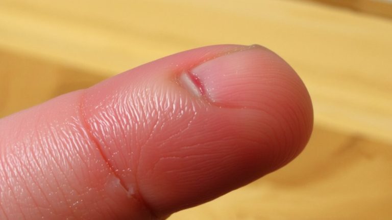 healing cuticle trauma areas