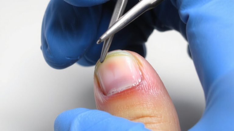 preserve perionychium during removals