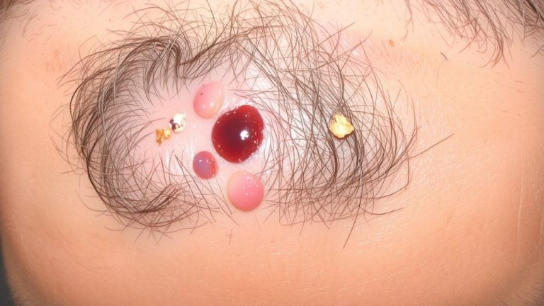 recognize and treat scalp folliculitis