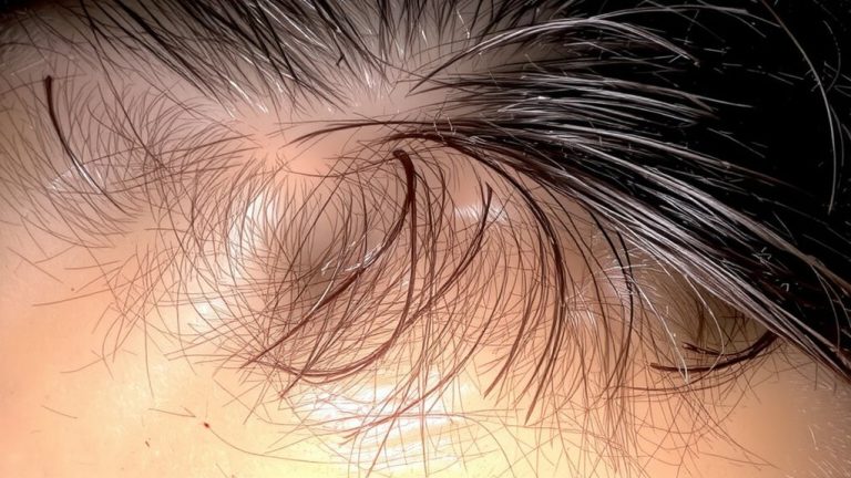 scalp health impacts hair color